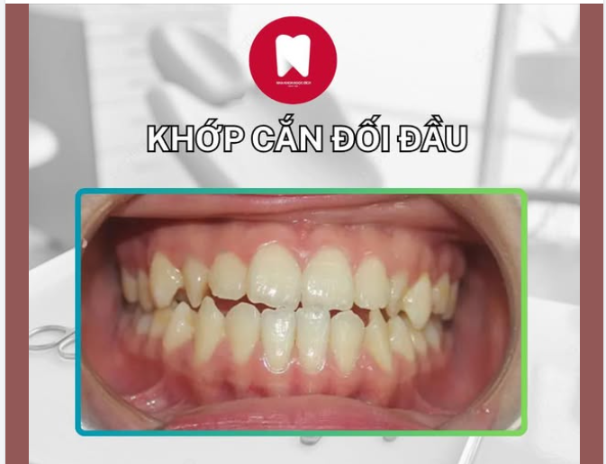 NIỀNG RĂNG - GIẢI PHÁP KHẮC PHỤC DỨT ĐIỂM TÌNH TRẠNG KHỚP CẮN ĐỐI ĐẦU