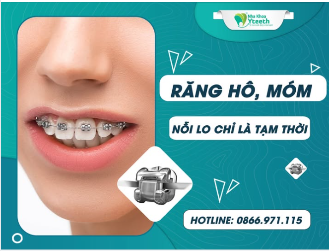 Những nỗi lo về một nự cười nhiều răng hay răng món đó chỉ là tạm thời. Bởi vì bạn hoàn toàn có thể thay đổi.