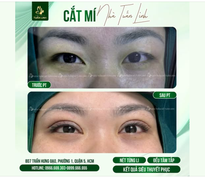 CẮT MÍ – BÍ QUYẾT CHO ĐÔI MẮT TO TRÒN, CUỐN HÚT !!