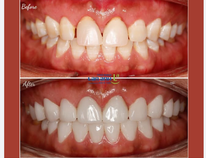 Veneer siêu mỏng được làm tại nha khoa Lan Anh: phù hợp thay đổi hình dạng, bề mặt răng, được gắn chính xác để đạt độ bền lâu dài ạ