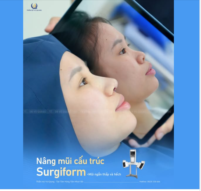 KHÁM PHÁ KẾT QUẢ NÂNG MŨI SURGIFORM CỦA CÔ NÀNG ĐƯỢC CHỒNG “HỘ TỐNG” ĐI LÀM ĐẸP