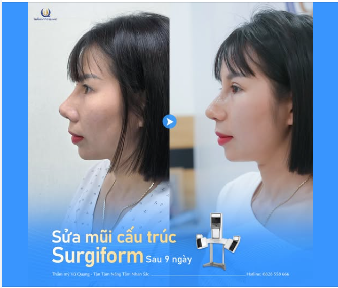 Sau 9 ngày sửa mũi, cô nàng HT đã tự tin khoe dáng mũi mới xinh đẹp chuẩn Tây!