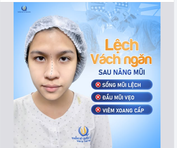 LỆCH VẸO VÁCH NGĂN, VIÊM XOANG SAU NÂNG MŨI – PHẢI LÀM SAO