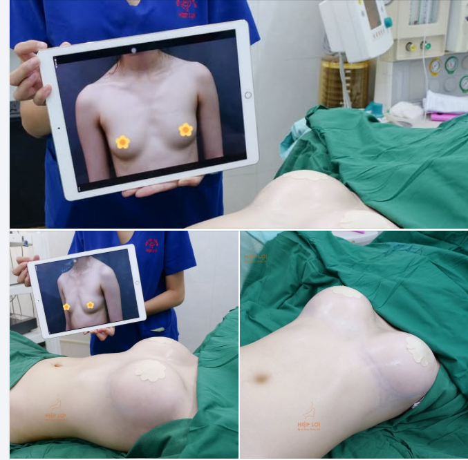 KẾT QUẢ THỰC TẾ SAU CA NÂNG NGỰC TẠI HIỆP LỢI