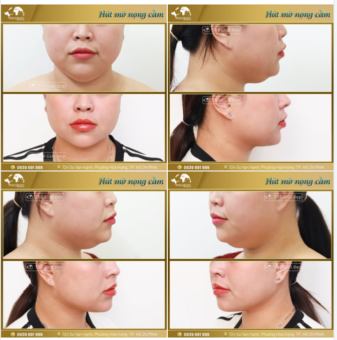 Giải quyết nọng cằm nhanh chóng giúp định hình đường nét gương mặt gọn gàng hơn mà không cần phẫu thuật phức tạp!