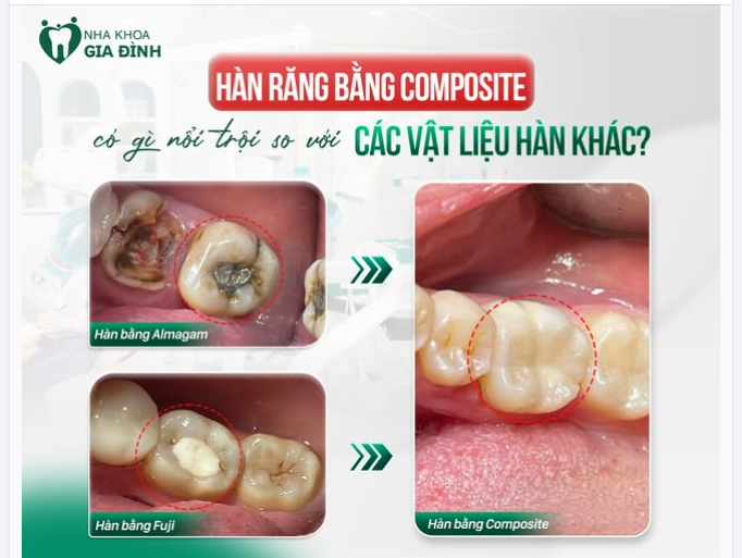 HÀN RĂNG BẰNG COMPOSITE CÓ GÌ NỔI TRỘI SO VỚI CÁC VẬT LIỆU HÀN KHÁC?