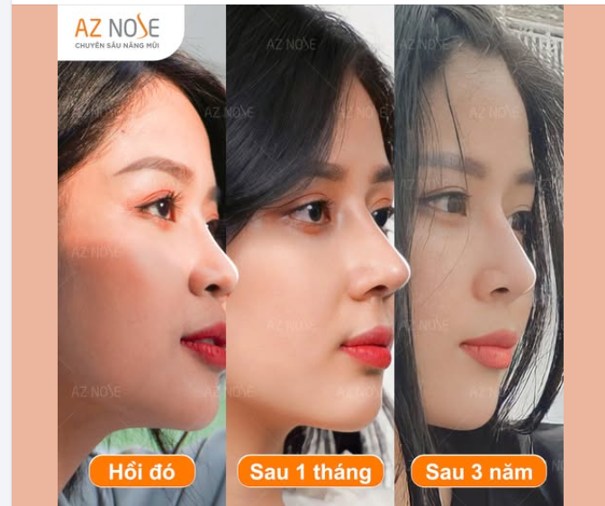 MC Cao Vy tự tin hơn, khí chất hơn sau 3 năm nâng mũi