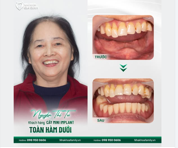 TÁI SINH NỤ CƯỜI, ĂN NGON SỐNG KHỎE NHỜ TRỒNG RĂNG IMPLANT