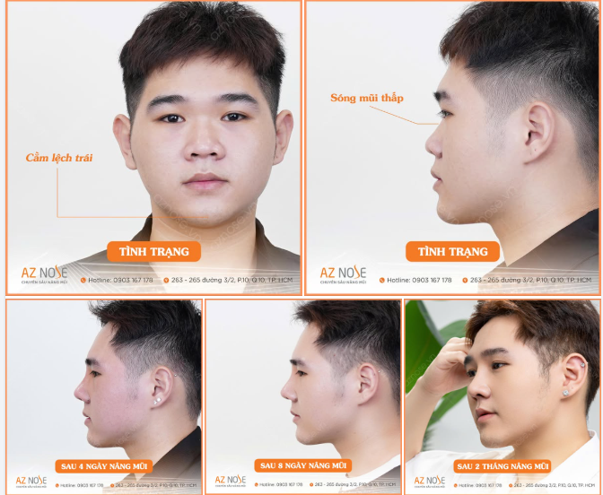 Nam sinh  NTTU sau 2 tháng nâng mũi - khác biệt lớn đến từ chi tiết nhỏ