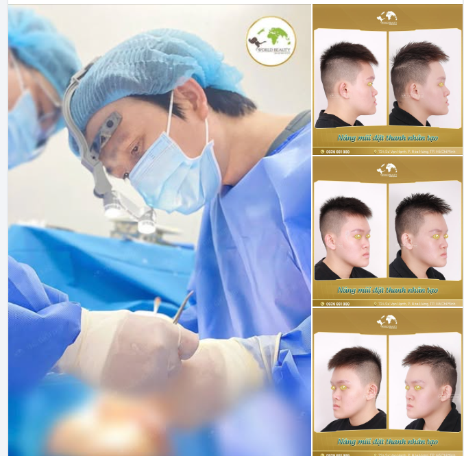 NÂNG MŨI ĐẶT THANH NHÂN TẠO GIẢI PHÁP TINH CHỈNH DÁNG MŨI