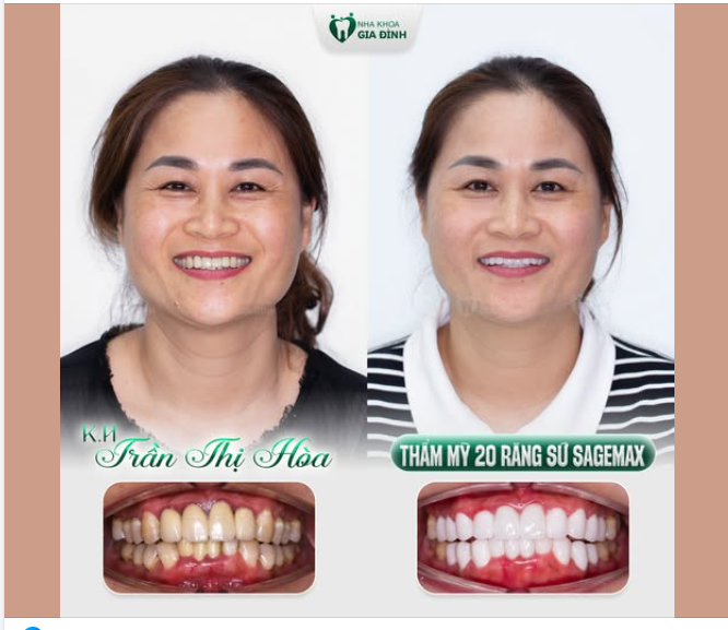 THAY RĂNG SỨ XUỐNG CẤP - ĐỔI NỤ CƯỜI TỰ TIN