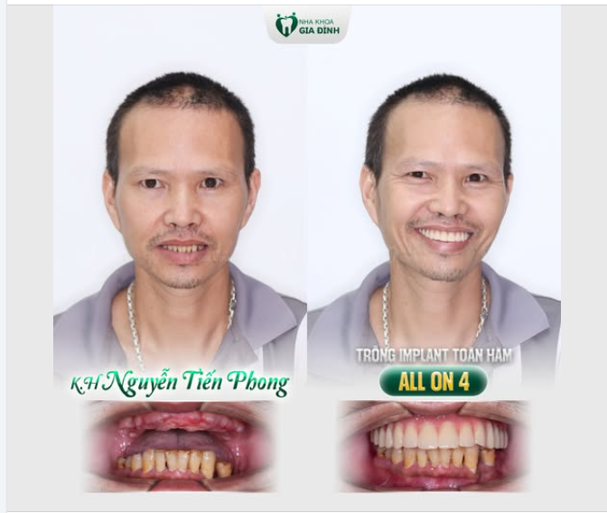 Trồng răng đúng lúc - Ăn ngon ngủ sâu - Sống vui sống lâu
