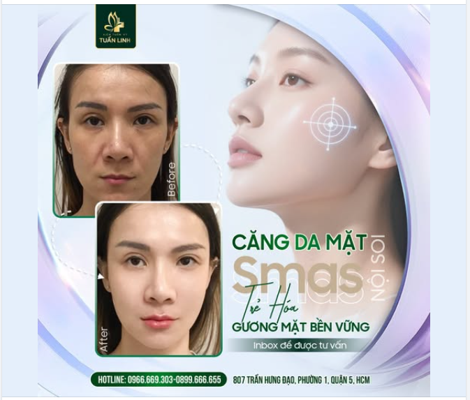 CĂNG DA MẶT SMAS – GIẢI PHÁP TRẺ HÓA TOÀN DIỆN!!
