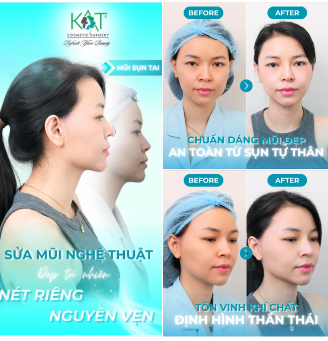  MŨI SỤN TAI GIẢI PHÁP TINH CHỈNH DÁNG MŨI TỰ NHIÊN , GIỮ TRỌN NÉT RIÊNG