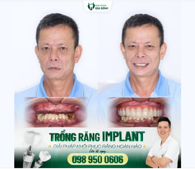 Tạm biệt mất răng, ăn nhai kém - Chào đón cuộc sống trọn niềm vui!