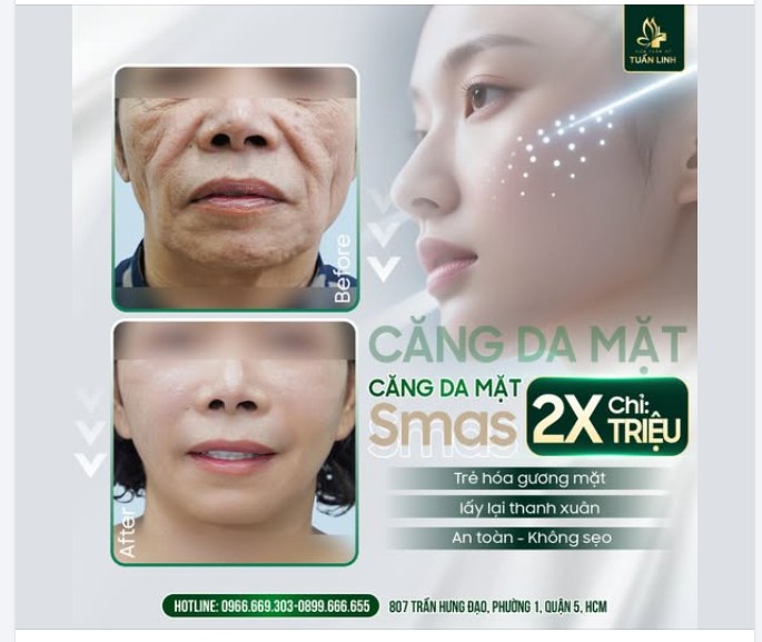 CĂNG DA MẶT SMAS GIÁ CHỈ 2XTR - BÍ QUYẾT LẤY LẠI THANH XUÂN CHỈ SAU 60 PHÚT!!