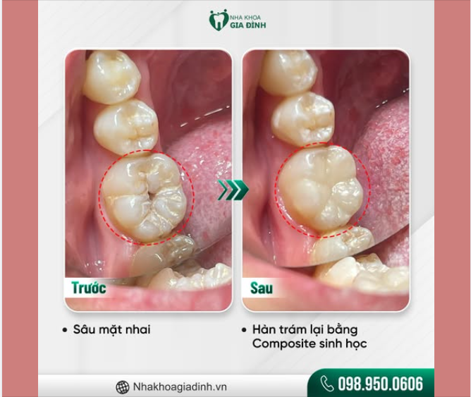 HÀN RĂNG SÂU - BẢO VỆ RĂNG CHẮC KHỎE