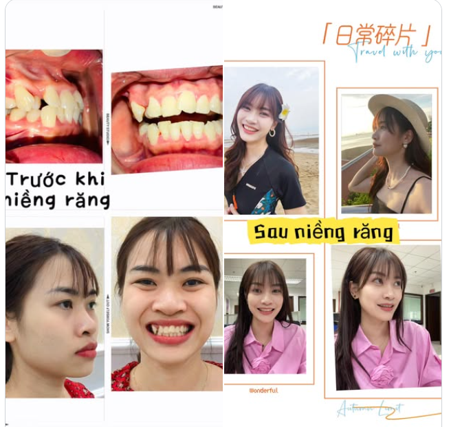 "Nạn nhân" của niềng răng, nhưng là một nạn nhân… vô cùng mãn nguyện