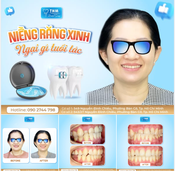 NIỀNG RĂNG XINH - NGẠI GÌ TUỔI TÁC