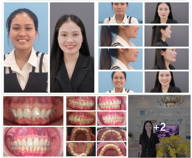 Nụ cười này đã đi qua không ít tháng ngày với mắc cài và kiên trì