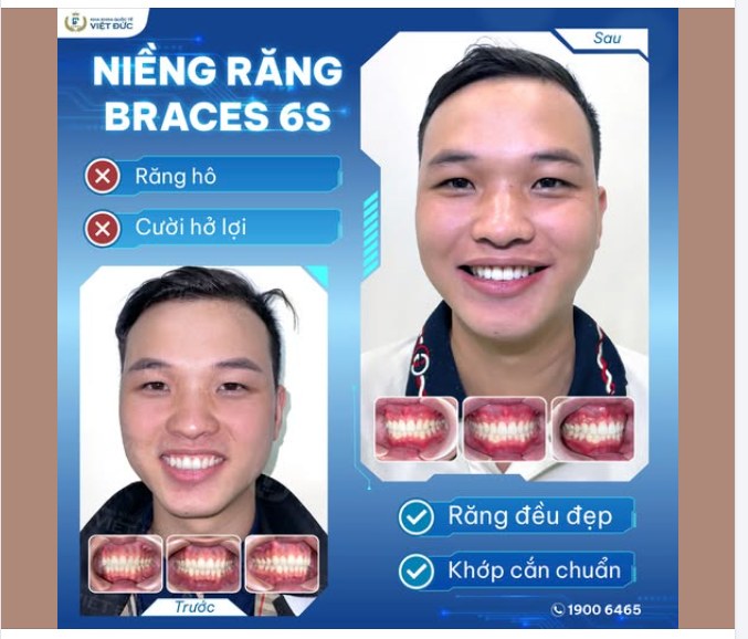 TẠM BIỆT NỤ CƯỜI HỞ LỢI - CHÀO ĐÓN NỤ CƯỜI TỰ TIN RẠNG NGỜI