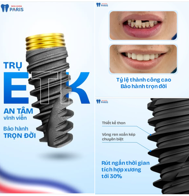 Trụ ETK - An tâm vĩnh viễn - Bảo hành trọn đời