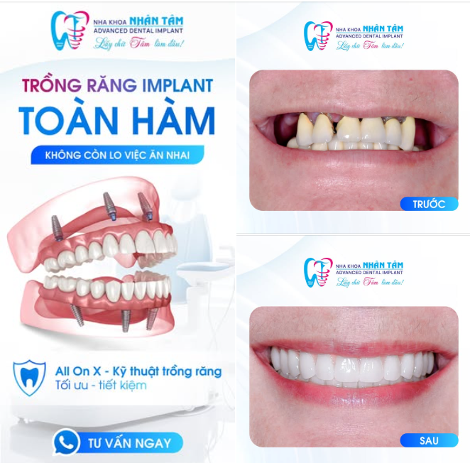 62 TUỔI VẪN CÓ THỂ PHỤC HỒI RĂNG TOÀN HÀM