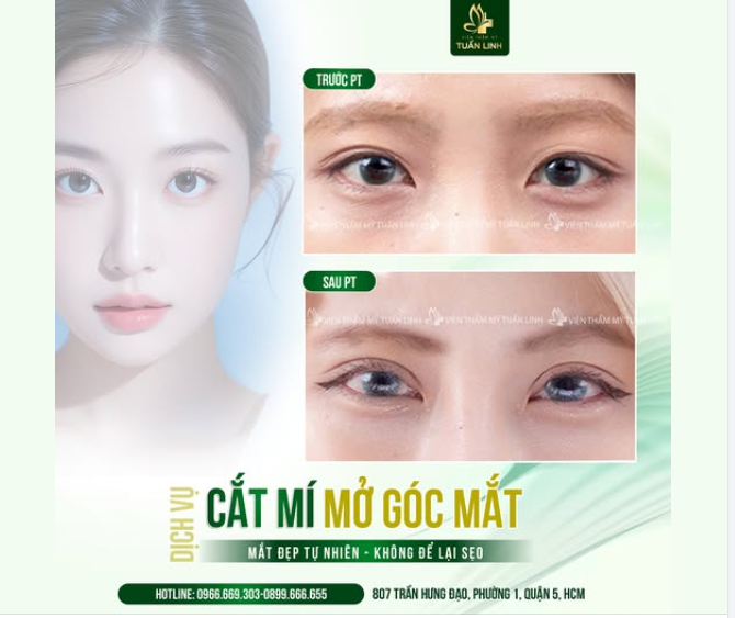 CẮT MÍ – MỞ GÓC MẮT: ĐÔI MẮT TO TRÒN, CUỐN HÚT TỰ NHIÊN - GIÁ ƯU ĐÃI