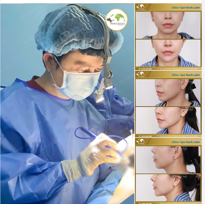 Muốn thay đổi dáng cằm nhưng còn phân vân?