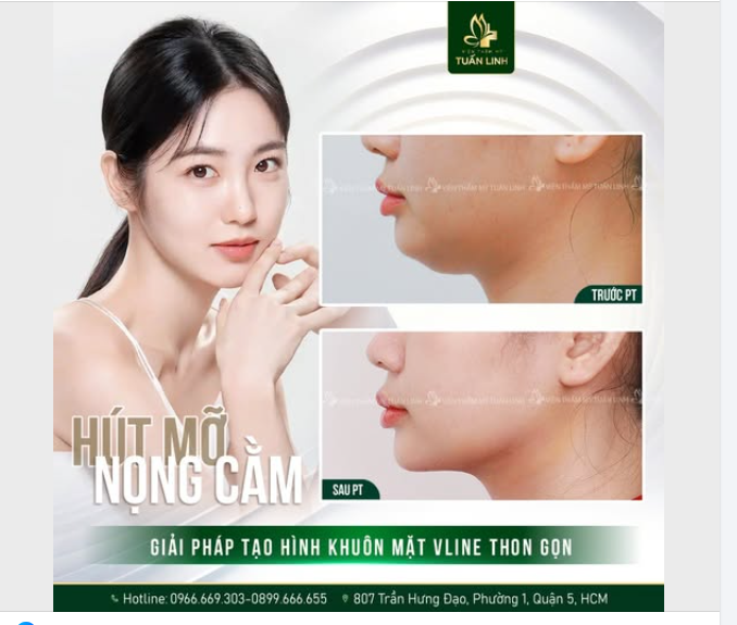 HÚT MỠ NỌNG CẰM - GIẢI PHÁP TẠO HÌNH KHUÔN MẶT VLINE THON GỌN!!!