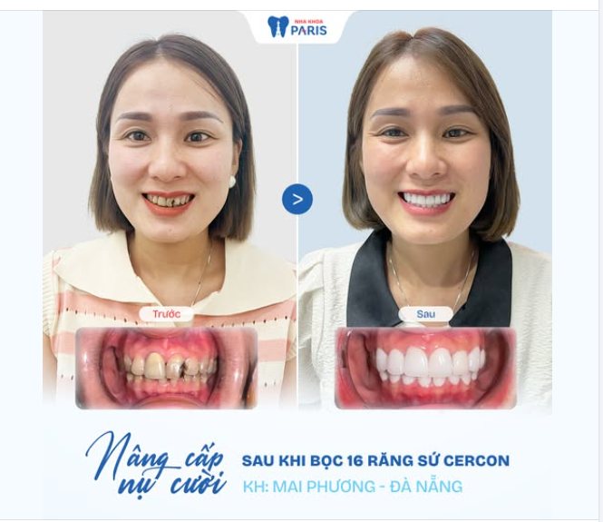 Chị Mai Phương đến Nha khoa Paris trong tình trạng răng sứt mẻ, xỉn màu nặng, kém thẩm mỹ.