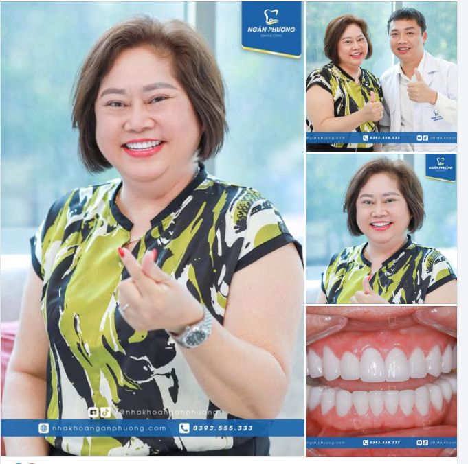 Hơn cả một bộ răng đẹp là bộ răng trắng sáng, khỏe mạnh, nụ cười rạng rỡ tràn đầy hạnh phúc của chị đẹp Việt kiều Nga
