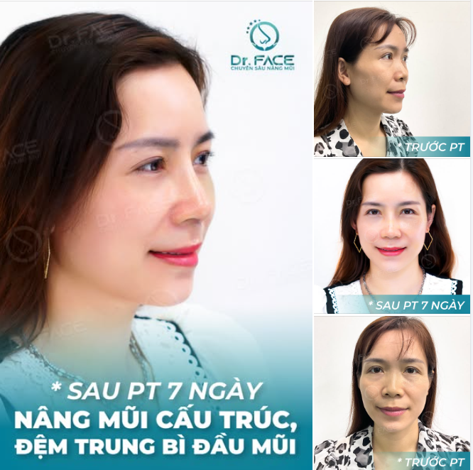 Hành trình YÊU BẢN THÂN bắt đầu từ CHIẾC MŨI ĐẸP