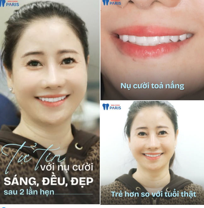 "Thoát cảnh" răng XỈN MÀU, Ố VÀNG, HÔ THƯA - mà không mài nhỏ răng