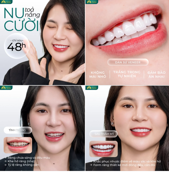 “Mình từng ngại cười vì răng ố vàng, không đều...  Không nghĩ chỉ 48h có thể thay đổi mọi thứ với  Dán Sứ Veneer"