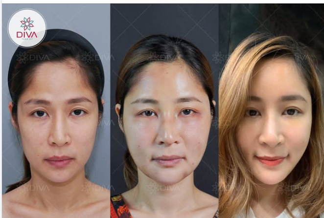 CẢI THIỆN TRÁN HÓP – LÕM SÂU NHỜ PHƯƠNG PHÁP CẤY MỠ COLEMAN