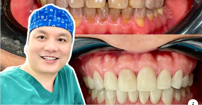 Bọc răng sứ giữ được bao lâu và hướng dẫn chăm sóc sau bọc răng
