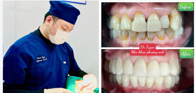 Răng sứ HT Smile