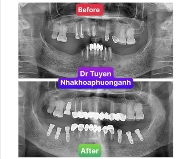 Ai Là Người Phù Hợp Để Làm Implant Răng?