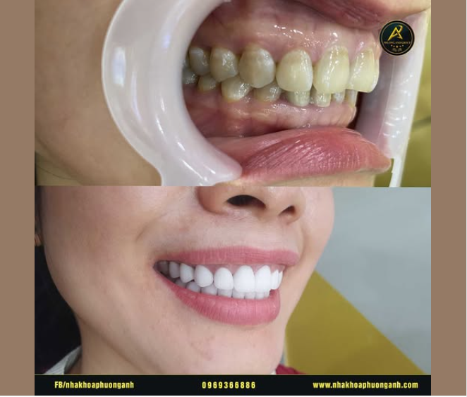 Răng thật ảnh hưởng đến đến răng sứ