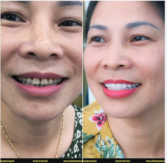 Răng sứ HT Smile