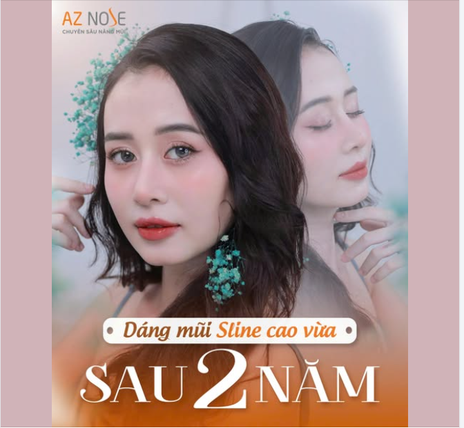 Chị T.N. (Trà Vinh) chia sẻ cả chị và gia đình đều rất hài lòng với dáng mũi mới, giúp gương mặt chị nhìn hài hòa hơn hẳn.