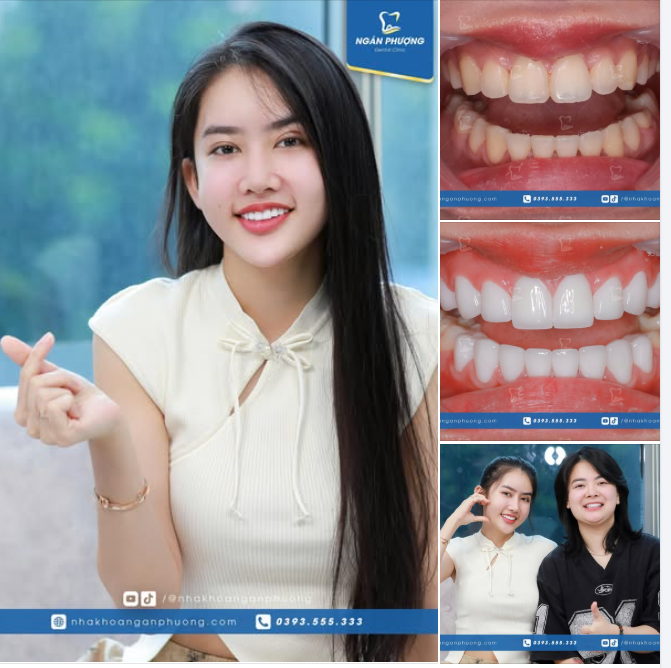 Cảm ơn chị Phúc Hậu và chị Thúy Nga đã tin tưởng đặt trọn niềm tin nơi Nha khoa Ngân Phượng.