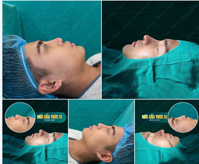 NÂNG MŨI CHO NAM GIỚI – THAY ĐỔI NHẸ, KHÍ CHẤT LÊN HẲN!