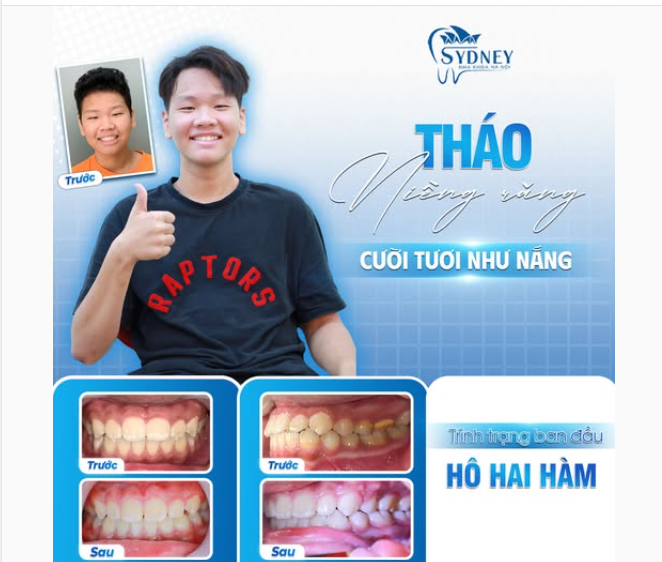 THÁO NIỀNG RĂNG - CƯỜI TƯƠI NHƯ NẮNG