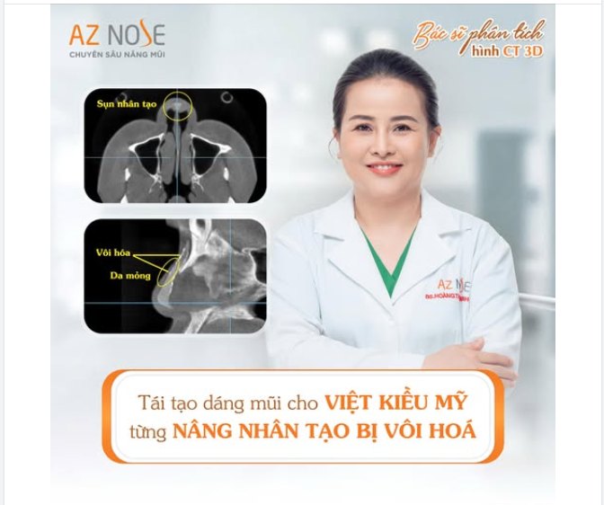 Tư vấn tái tạo dáng mũi cho Việt kiều Mỹ từng nâng nhân tạo