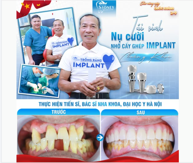 TÁI SINH NỤ CƯỜI NHỜ CẤY GHÉP IMPLANT CHUẨN Y KHOA