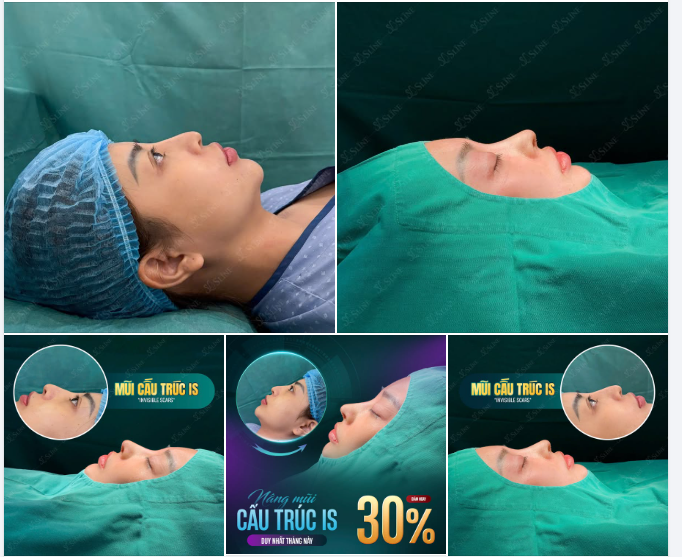 MŨI ĐẸP LÊN KHÍ CHẤT – CẢM NHẬN NGAY SAU KHI LÀM
