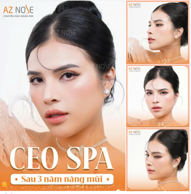  Chia sẻ của CEO Spa - chị S.T. sau 3 năm nâng mũi.