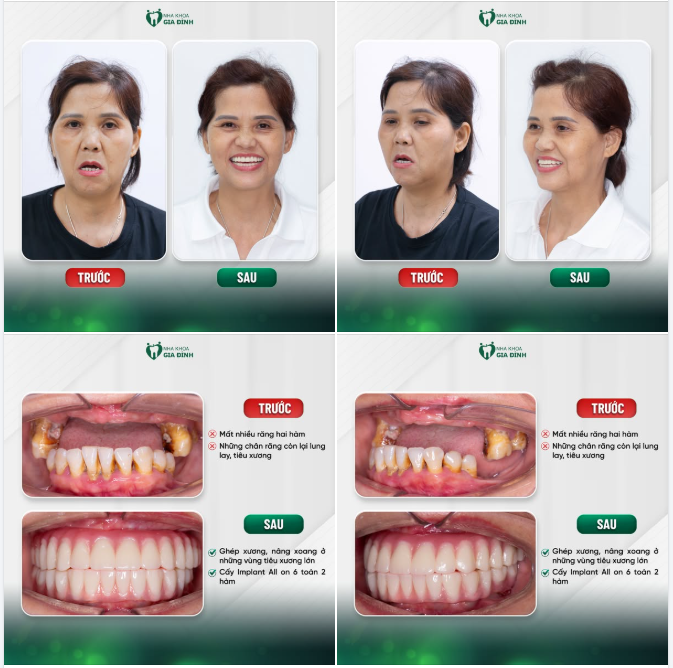 Hành trình tìm lại nụ cười khỏe mạnh của cô Nguyễn Thị Thủy